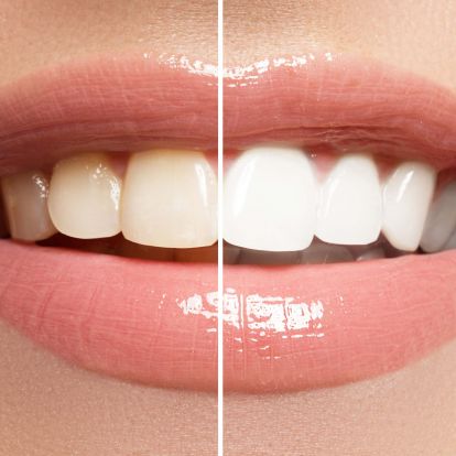 Bleaching
